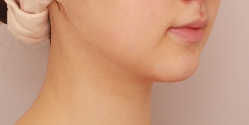 【頬＋顎下】ベイザー併用脂肪吸引でより理想のフェイスラインに！