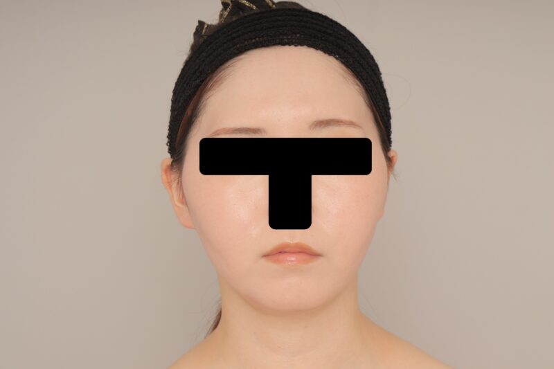 ベイザー脂肪吸引（１ヶ月経過：27）の術後写真