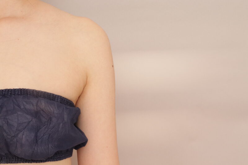 20代女性のふりそで部分の脂肪吸引、1か月経過のご紹介です。