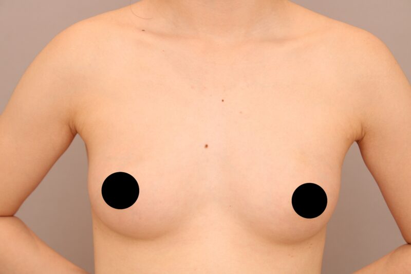 脂肪豊胸でそげ感のあるデコルテをふっくらと張りのある印象に！