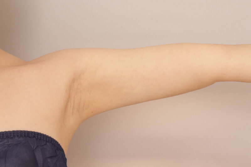 30代女性の二の腕と脇肉の脂肪吸引、１か月経過のご紹介です。