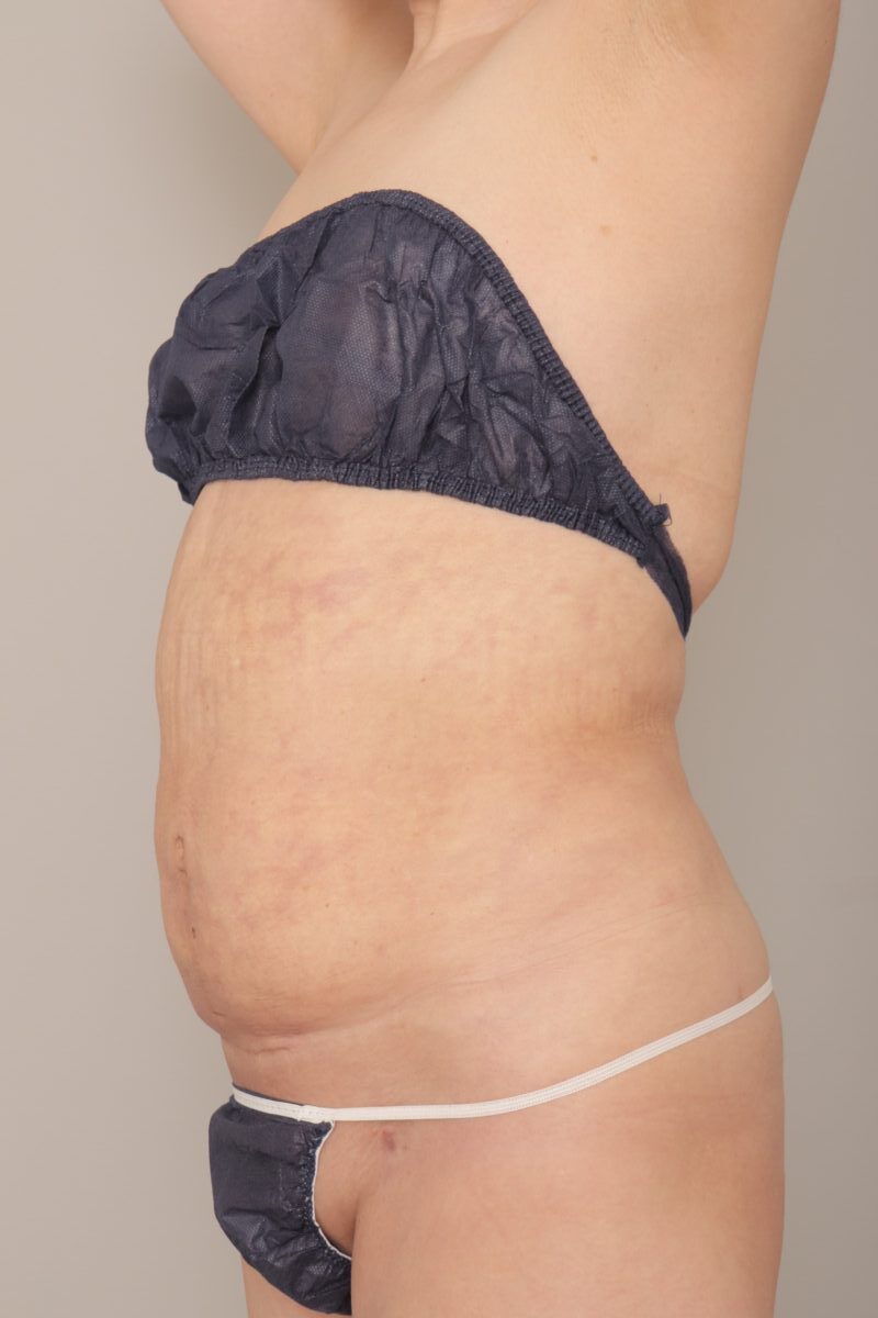50代女性、BMI25の方のお腹と腰の脂肪吸引：３か月経過のご紹介です