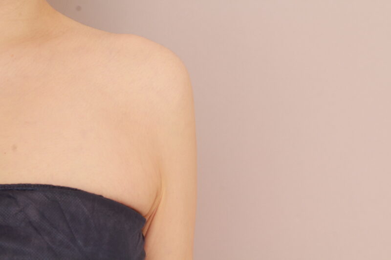 二の腕のふりそで、外張りには脂肪吸引がおススメです！