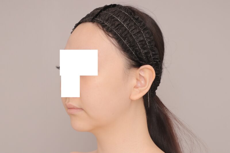 ベイザー脂肪吸引(3ヶ月経過:24)の術前写真