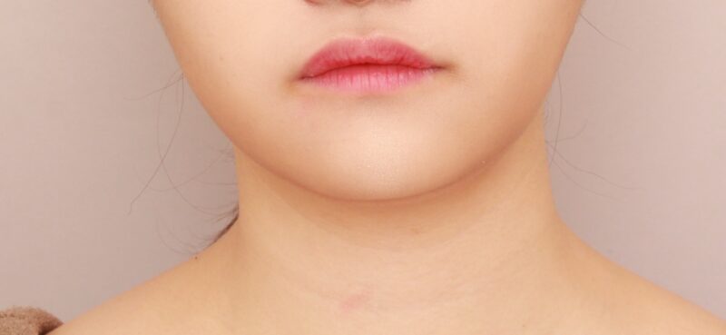 【頬＋顎下】頬と顎下の吸引でフェイスラインをよりシャープに！