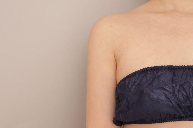 30代女性、二の腕と脇肉の脂肪吸引の３か月経過のご紹介です。