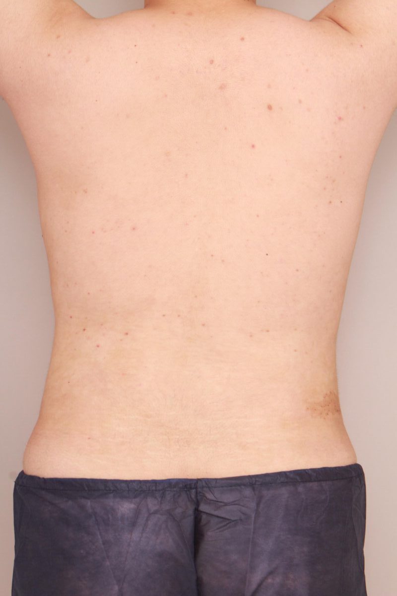 男性の腰回りも脂肪吸引でスッキリシルエットに！