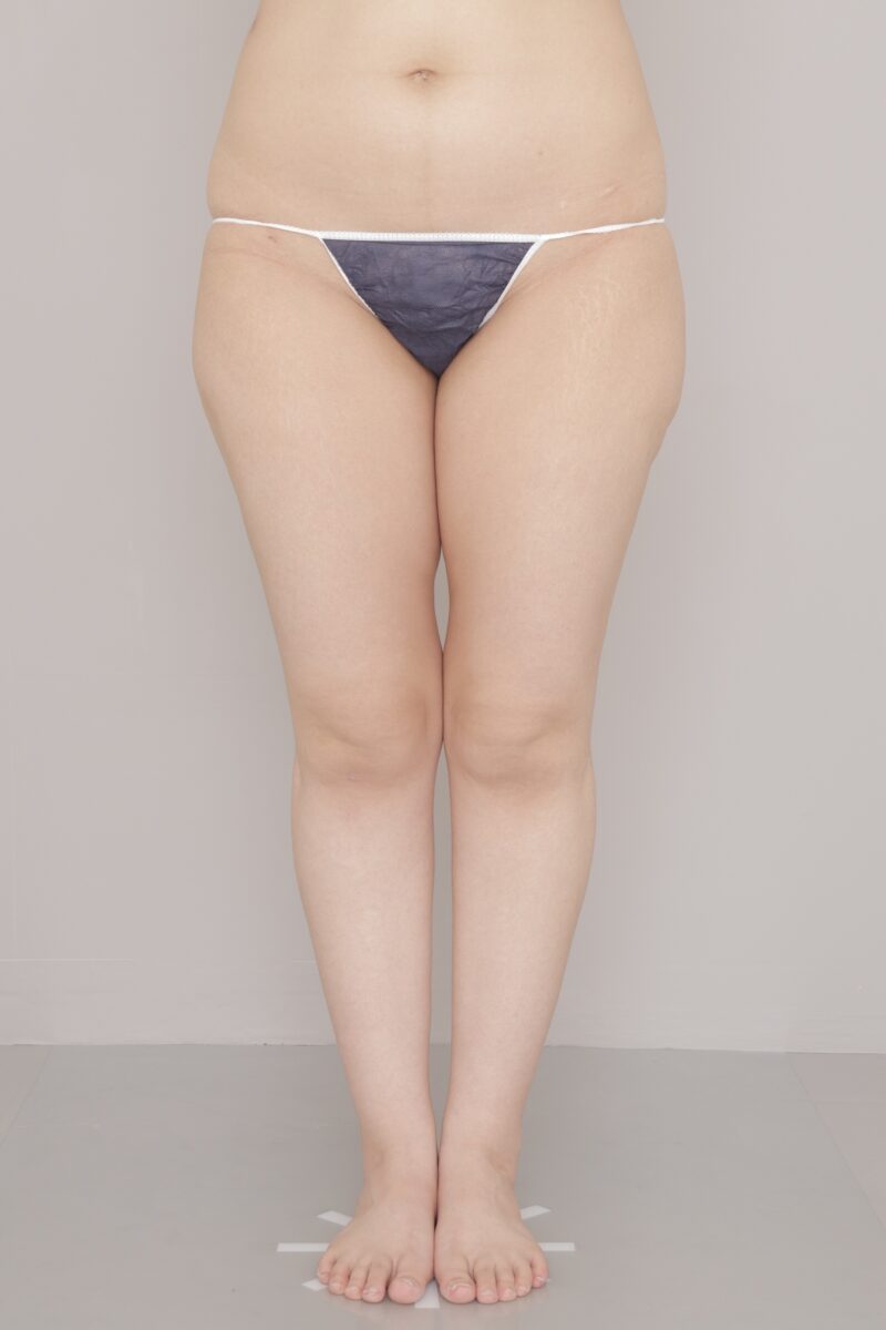 ベイザー脂肪吸引（3ヶ月経過：39）の術前写真