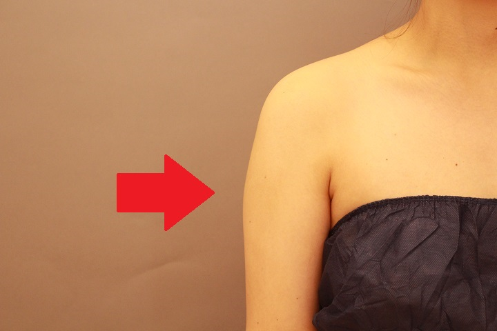 二の腕の脂肪吸引 3か月経過