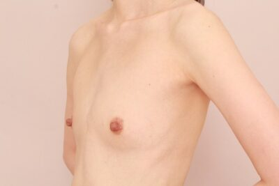 こんなに痩せている方でも可能です。