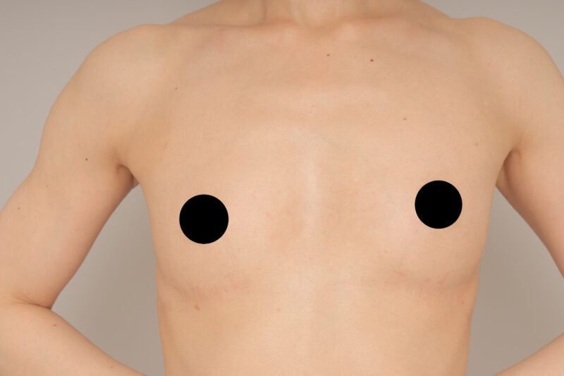 ベイザー脂肪吸引（半年後経過：32）の術前写真