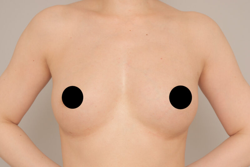 ベイザー脂肪吸引（半年後経過：32）の術後写真