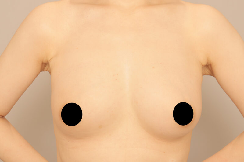 ベイザー脂肪吸引（1年3ヶ月後経過：45）の術後写真