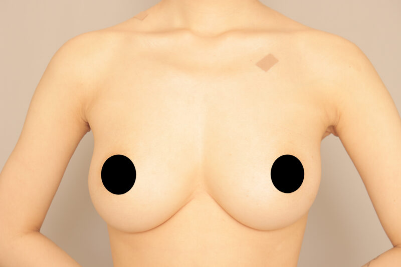 ベイザー脂肪吸引（半年後経過：25）の術後写真