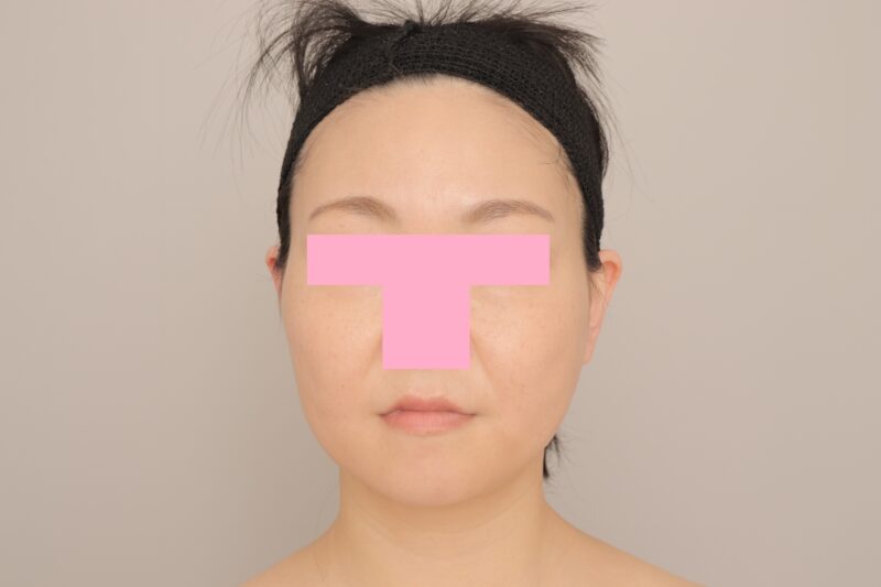 ベイザー脂肪吸引（6か月経過：35）の術後写真