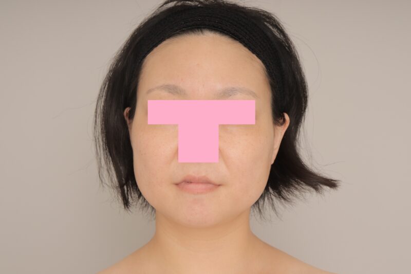 ベイザー脂肪吸引（6か月経過：35）の術前写真