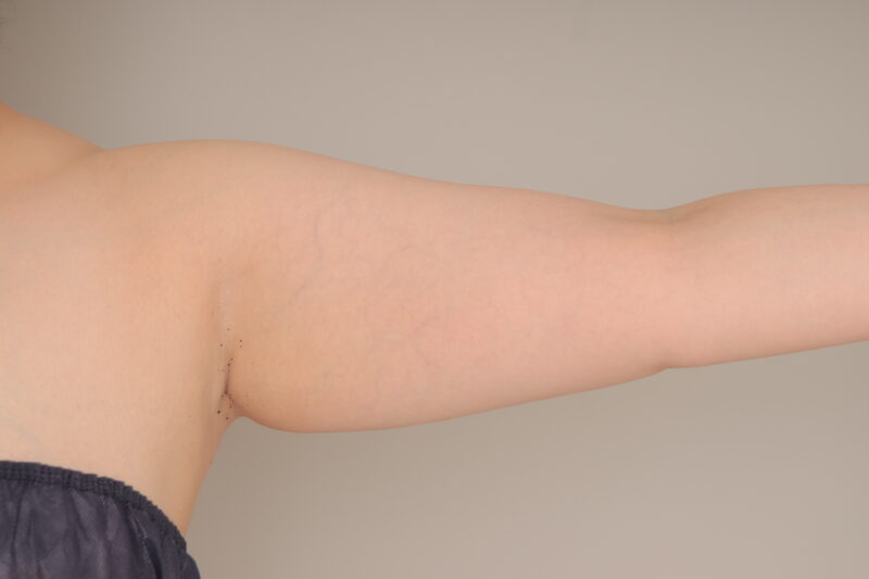 ベイザー脂肪吸引（6か月経過：44）の術前写真