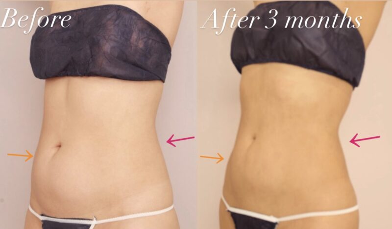 【腹部全体＋胸下＋腰】へそ周り/腰回りの深層脂肪を重点的に吸引！