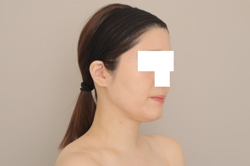 ベイザー脂肪吸引（3ヶ月経過：34）の術後写真