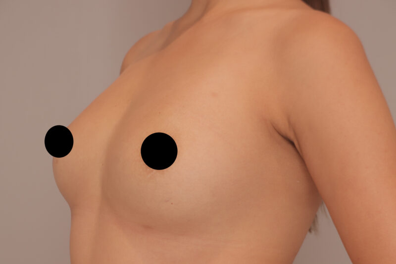 ベイザー脂肪吸引（1年半後経過：30）の術前写真