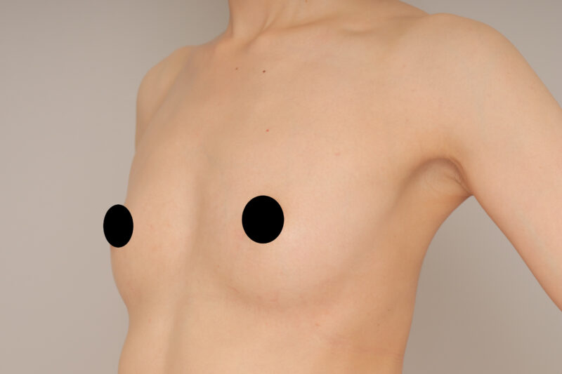 ベイザー脂肪吸引(半年後経過:32)の術前写真