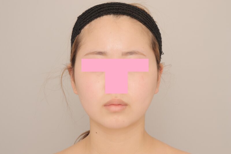 ベイザー脂肪吸引(6か月経過:19)の術後写真