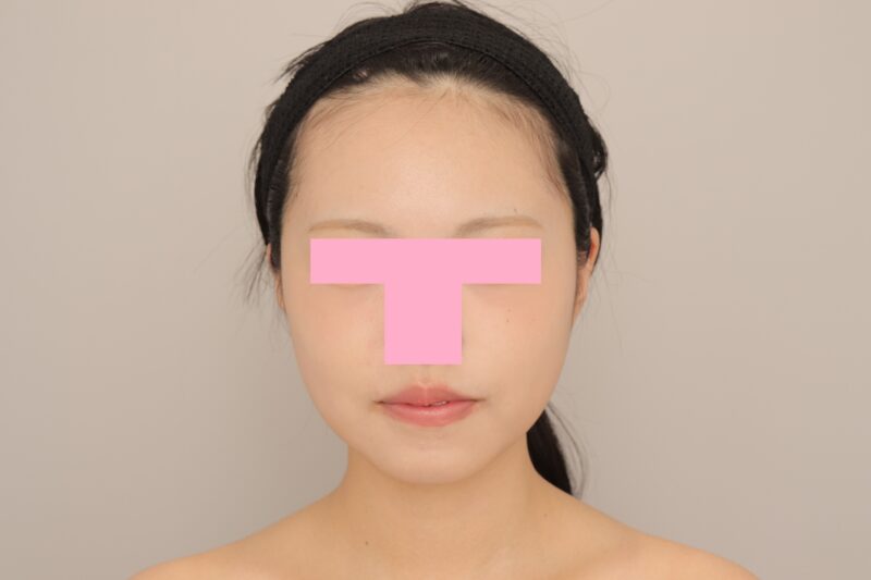 ベイザー脂肪吸引（6か月経過：21）の術後写真