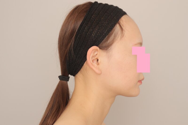 ベイザー脂肪吸引（6か月経過：25）の術後写真