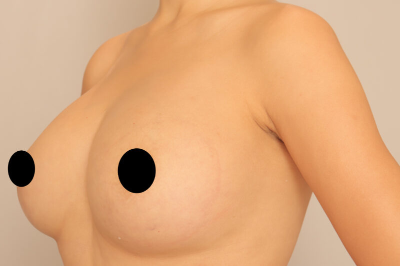 ベイザー脂肪吸引（1年半後経過：30）の術後写真