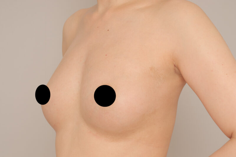 ベイザー脂肪吸引(半年後経過:32)の術後写真