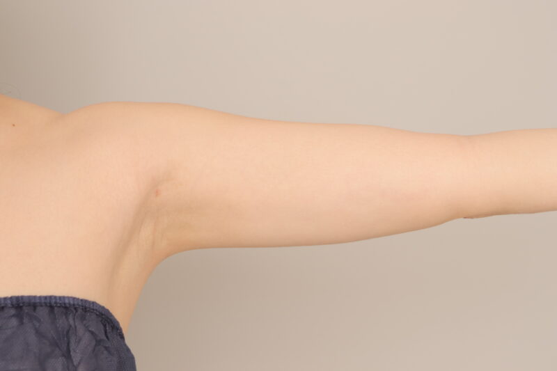 ベイザー脂肪吸引（3か月経過：35）の術後写真