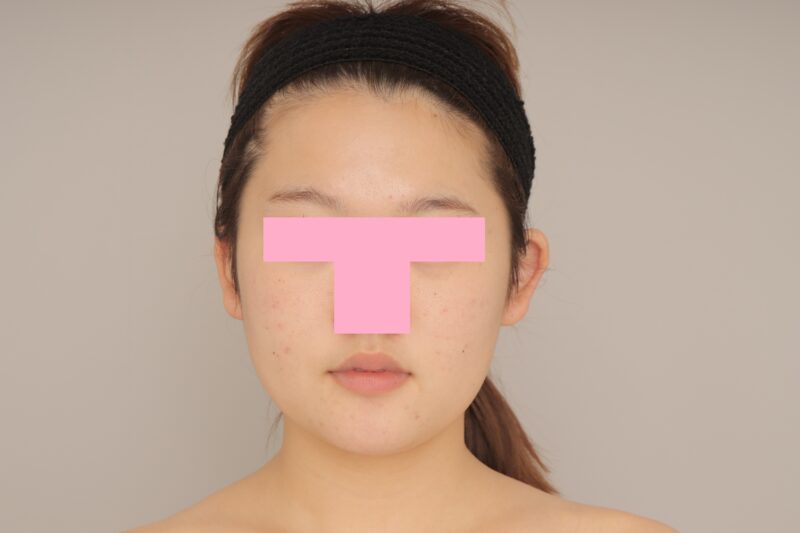 ベイザー脂肪吸引(3か月経過:21)の術前写真