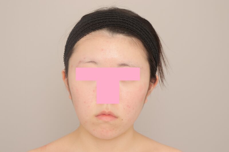 ベイザー脂肪吸引（3か月経過：18）の術後写真