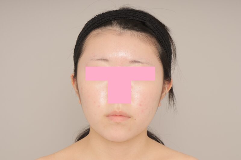 ベイザー脂肪吸引（3か月経過：18）の術前写真