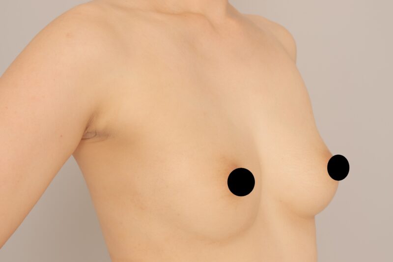 ベイザー脂肪吸引(3か月経過:31)の術前写真