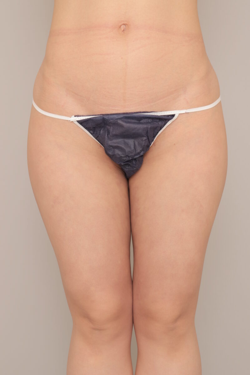 太腿脂肪吸引で細く。モニター様の1か月経過をご紹介♪　35歳 152cm 51kg