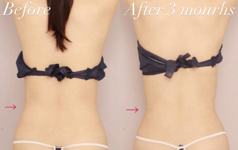 【腰】もともと細身の方がさらに理想のくびれを作るためにもお勧めの脂肪吸引です！