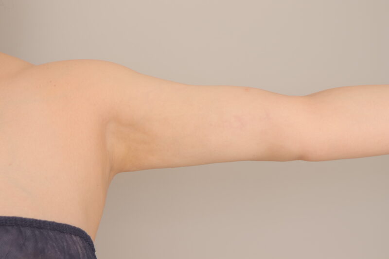 ベイザー脂肪吸引（6か月経過：44）の術後写真