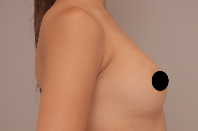 ベイザー脂肪吸引（1年半後経過：30）の術前写真