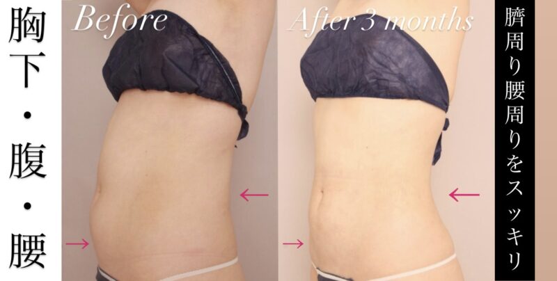 【腹部全体＋胸下＋腰部】下腹部、上腹部、側腹部のLocalized-Fat-Depositを効果的に吸引します！