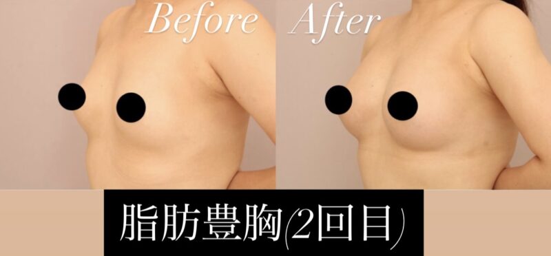 【脂肪豊胸×骨格ストレート(2回目)】 脂肪豊胸で変化を出しつつ自然なフォルムのバストに！