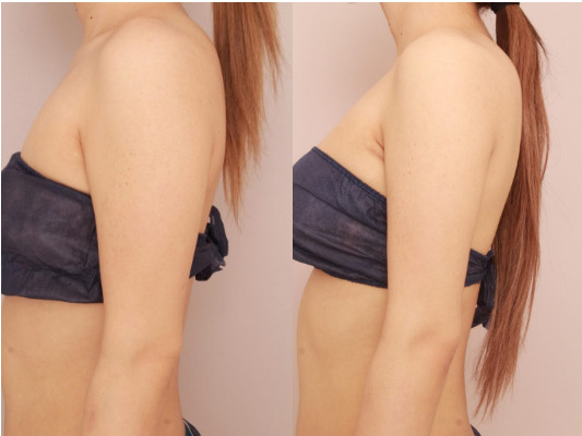 【上腕/肩】二の腕の脂肪吸引が向いている方の特徴は・・?