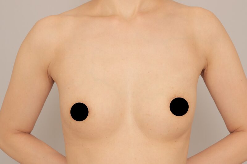 ベイザー脂肪吸引（3か月経過：38）の術後写真