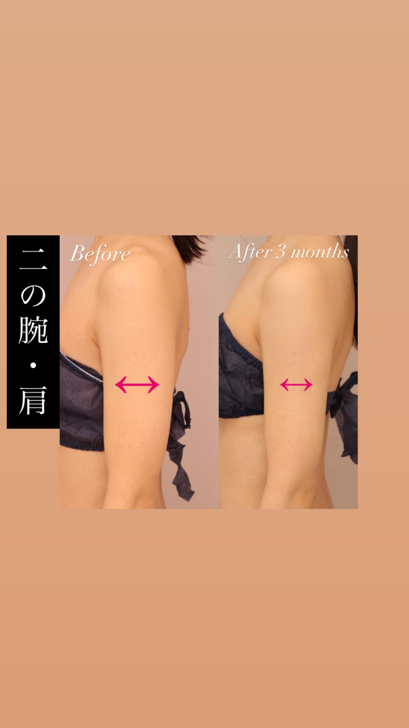 【二の腕+肩】脂肪吸引で直線的なシルエットの華奢腕に！