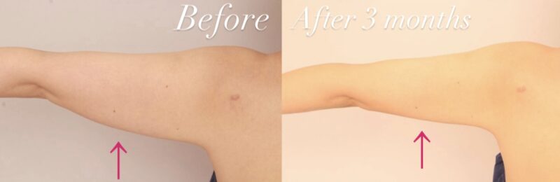 【上腕＋肩】骨格ウェーブさんの振りそでをスッキリ！