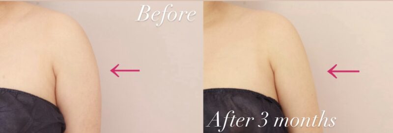 【上腕+肩】二の腕のボリュームや外張り、ふりそでをスッキリ！