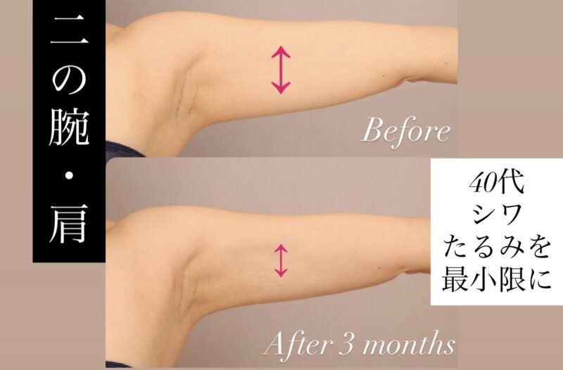 【二の腕+肩】40代以降の二の腕吸引～皮膚のシワやたるみをケア！～