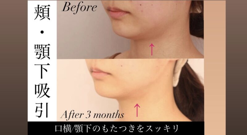 【頬＋顎下】口横と顎下のもたつきをスッキリ！