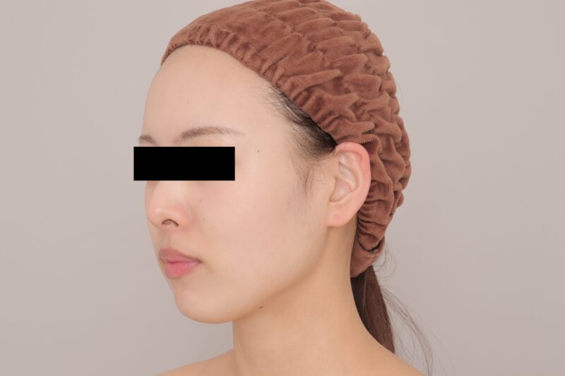 ベイザー脂肪吸引（3ヶ月経過：24）の術後写真