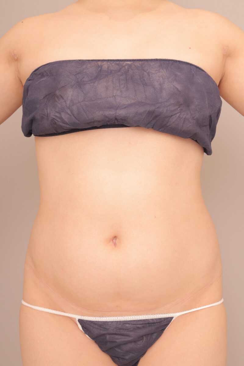 ベイザー脂肪吸引(半年後経過:37)の術前写真